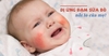 Trẻ Bị Dị Ứng Đạm Sữa Bò Nên Dùng Loại Sữa Nào? Top 10 Lựa Chọn Tốt Nhất