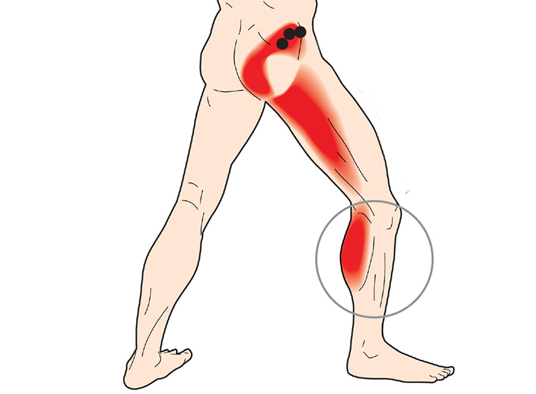 Nhảy dây bị đau bắp chân là do bạn chưa thực hiện đúng cách