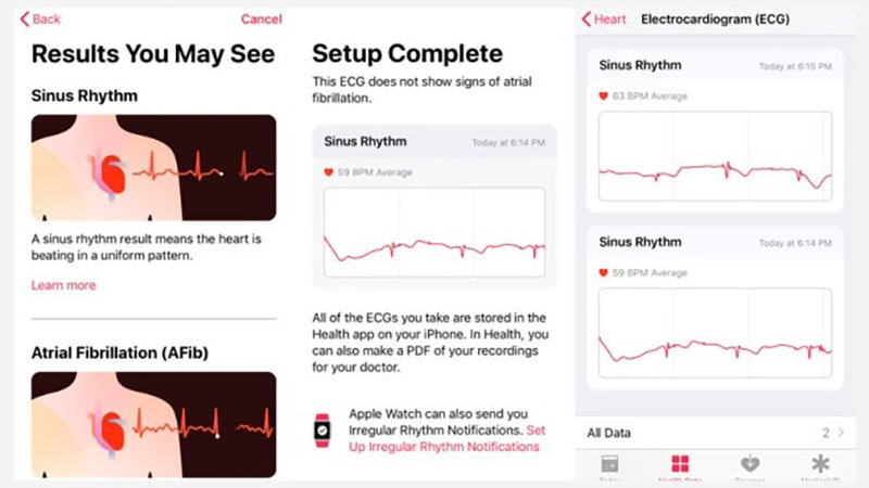 Tính năng ECG trên đồng hồ thông minh