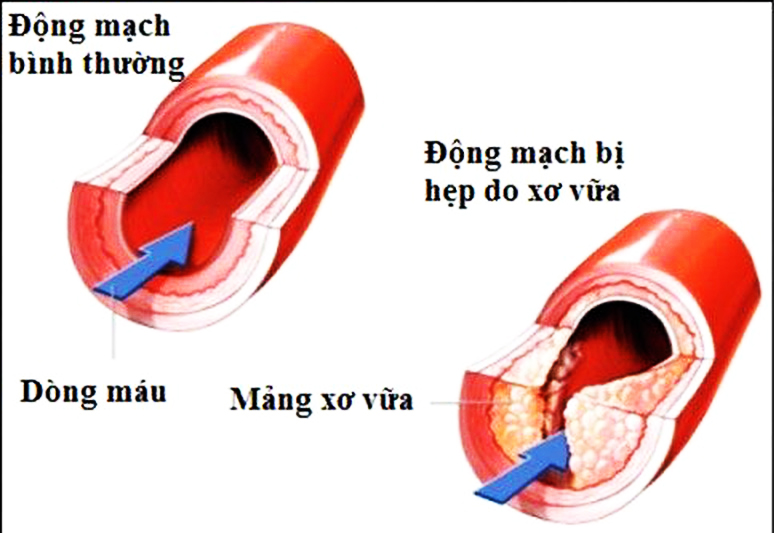 VTV.VN: Hồng sâm lên men enzyme - chống xơ vữa động mạch