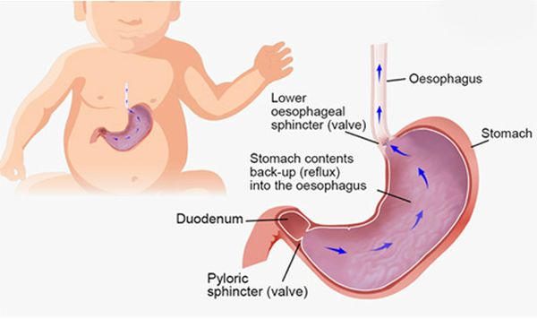trị trào ngược dạ dày ở bé