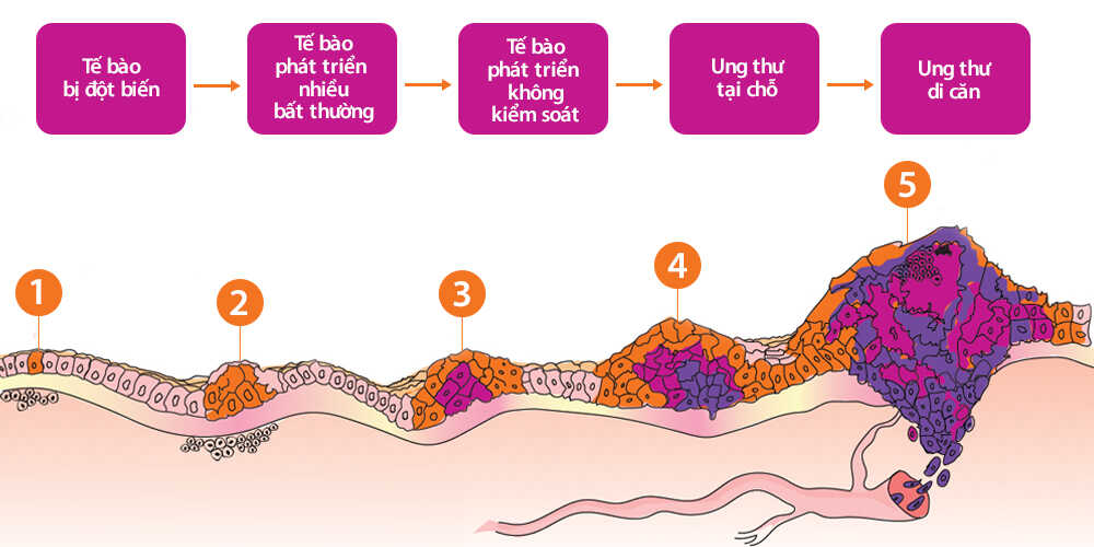 Các giai đoạn phát triển ung thư - dienmayklp.vn