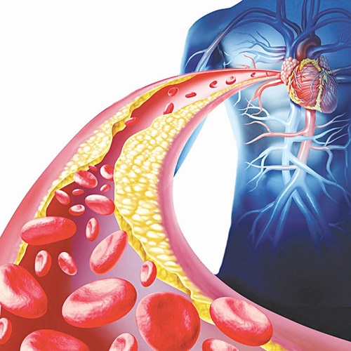 y-hoc-co-truyen-va-hoi-chung-roi-loan-lipid-mau