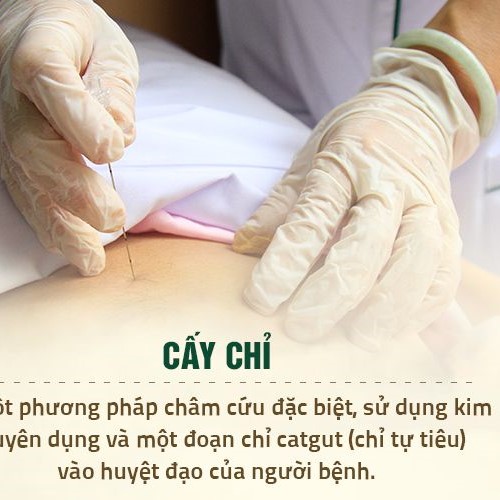 phuong-phap-cay-chi-y-hoc-co-truyen