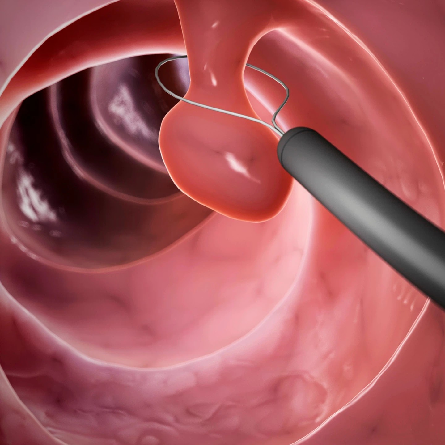 ba-bai-thuoc-kinh-dien-dung-cho-polyp-tui-mat-polyp-ruot-va-polyp-da-day