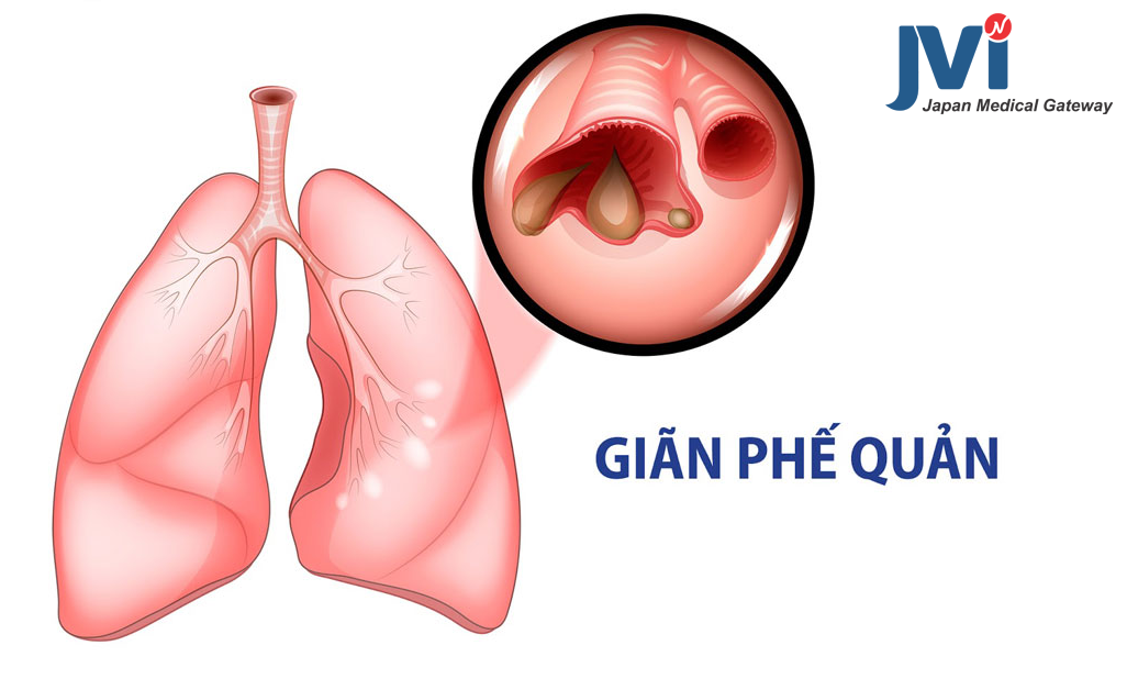 Giãn phế quản và những điều cần biết