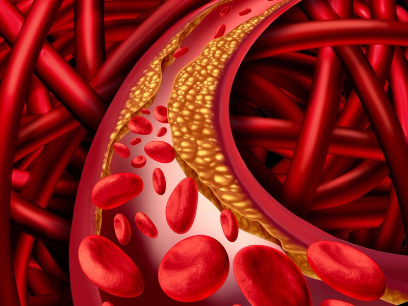 Rối loạn Lipid máu - Căn bệnh nguy hiểm ai cũng có thể mắc phải – jvi.com.vn