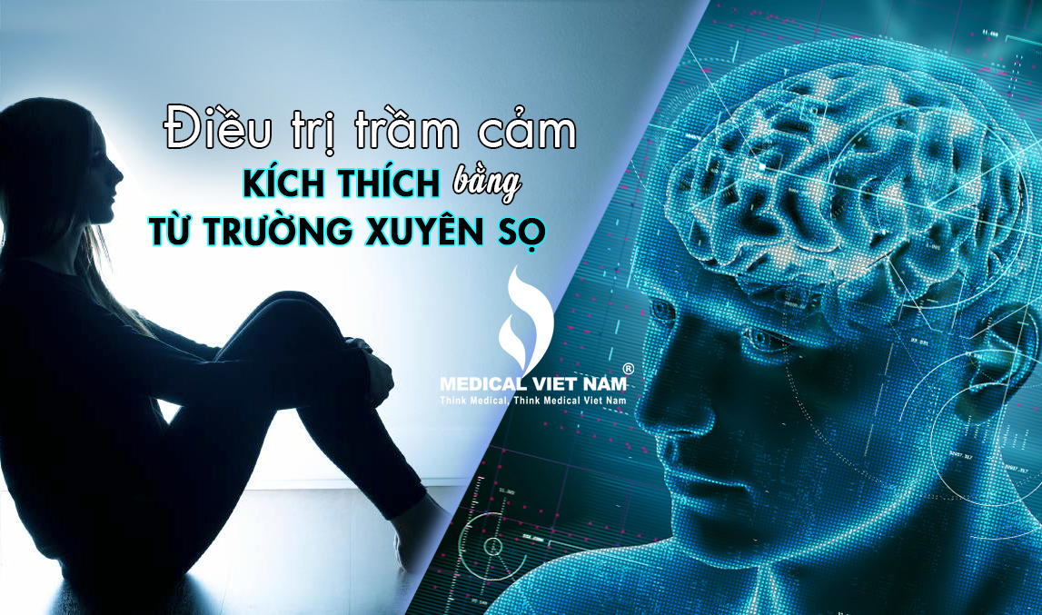 Điều trị trầm cảm bằng phương pháp kích từ xuyên sọ