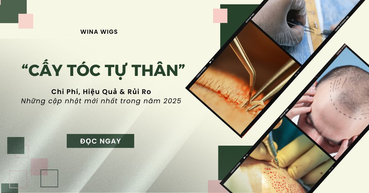 Cấy Tóc Tự Thân: Tất Cả Những Gì Bạn Cần Biết Về Chi Phí, Hiệu Quả Và Rủi Ro