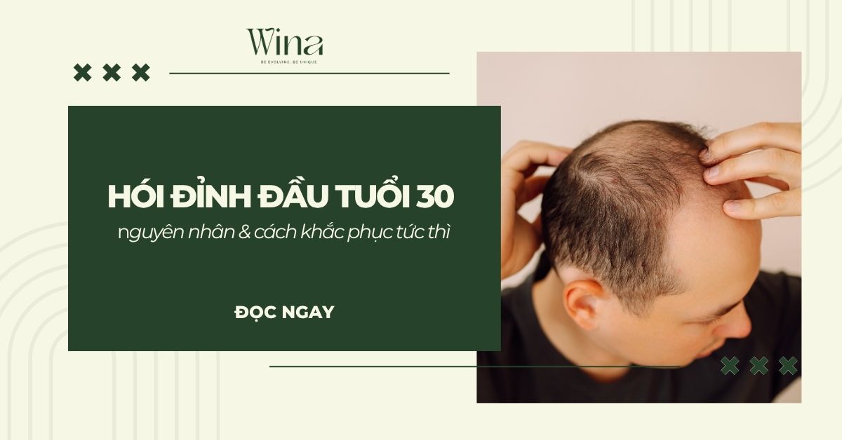 Hói Đỉnh Đầu Tuổi 30: Nguyên Nhân & Cách Khắc Phục Tức Thì