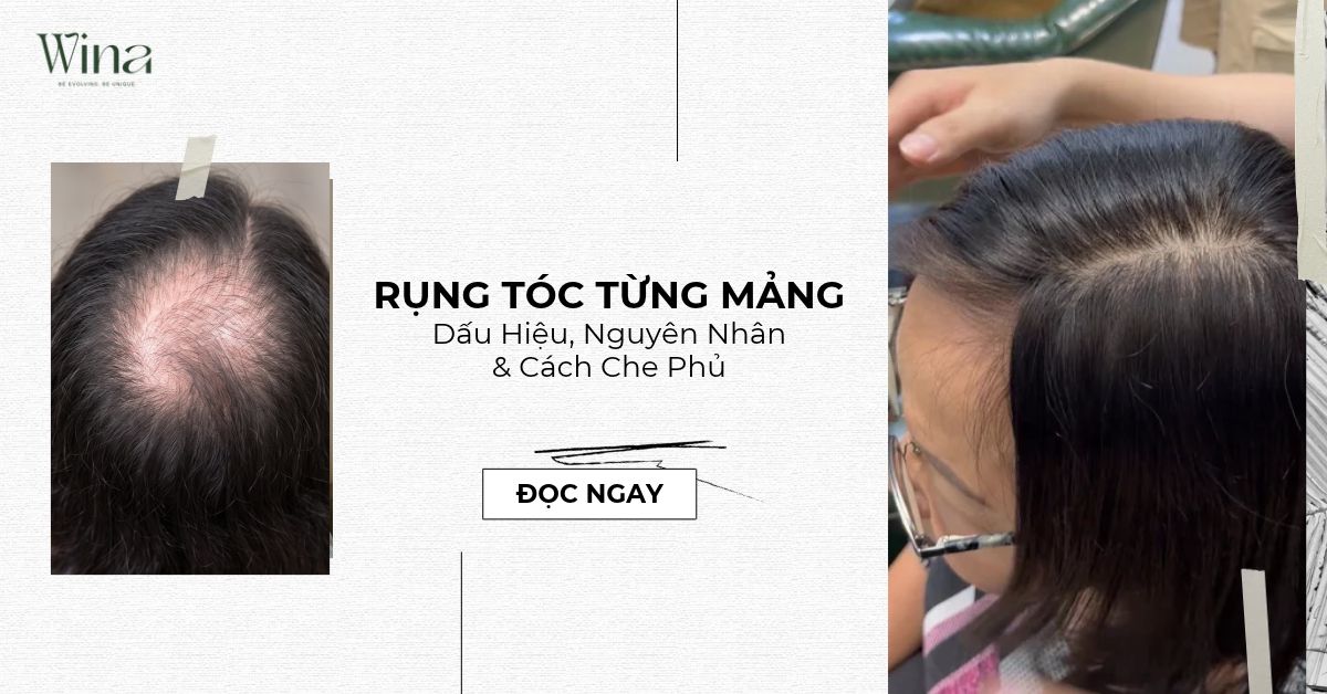 Rụng Tóc Từng Mảng: Dấu Hiệu, Nguyên Nhân & Cách Che Phủ