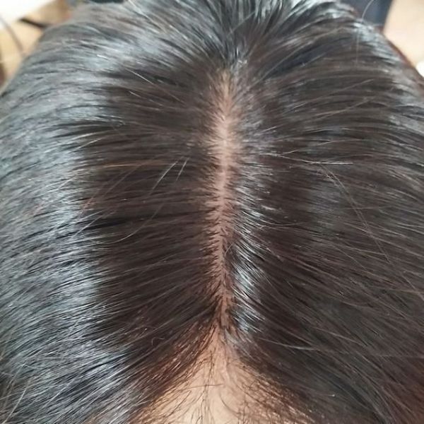Hói nhỏ, tóc chỉ rụng một phần nhỏ ở vùng trước trán hoặc đỉnh đầu
