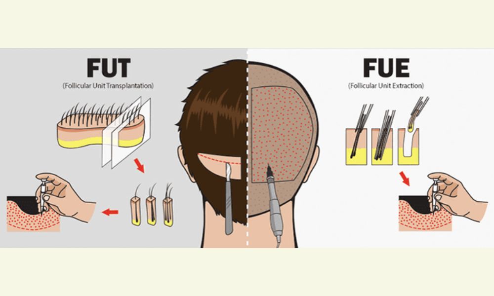 Hiện nay, có hai kỹ thuật cấy tóc tự thân chính được áp dụng rộng rãi, mỗi phương pháp đều có ưu và nhược điểm riêng