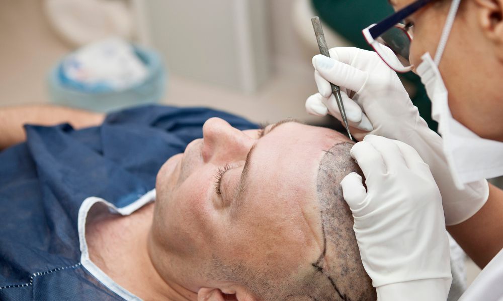 Chi phí cấy tóc là một trong những rào cản lớn nhất