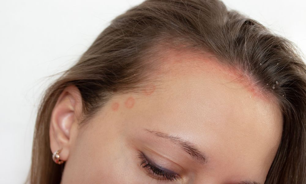 Viêm nang lông tại vùng cấy