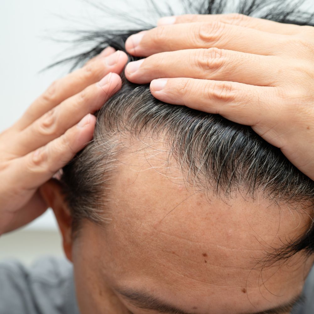 DHT là "kẻ thù" bóp nghẹt nang tóc, khiến chúng teo biến hoàn toàn ở vùng trán và đỉnh đầu