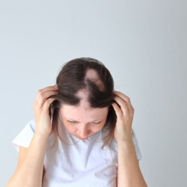 Rụng tóc nhiều có thể đang tiềm ẩn uy cơ bệnh tật