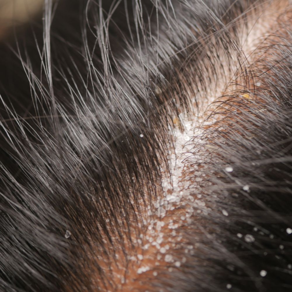 Da đầu khô do tuyến bã nhờn hoạt động kém