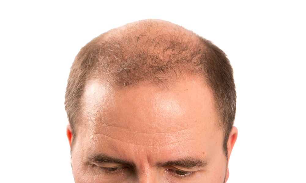 Ở những người có gen di truyền nhạy cảm với DHT, nó chính nguyên nhân gây hói đầu ở nam giới 