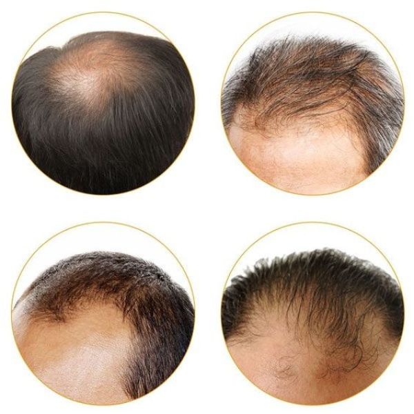 Thói quen hút thuốc lá, sử dụng nhiều rượu bia không chỉ ảnh hưởng đến sức khỏe tổng thể mà còn làm tóc trở nên yếu và mất đi độ chắc khỏe