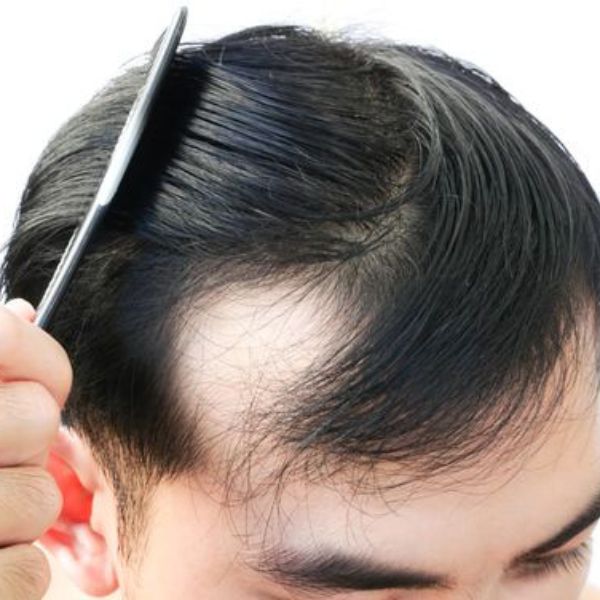 Rụng tóc nhiều ở nam giới đang trở thành một vấn đề phổ biến, đặc biệt là do áp lực công việc và cuộc sống hiện đại