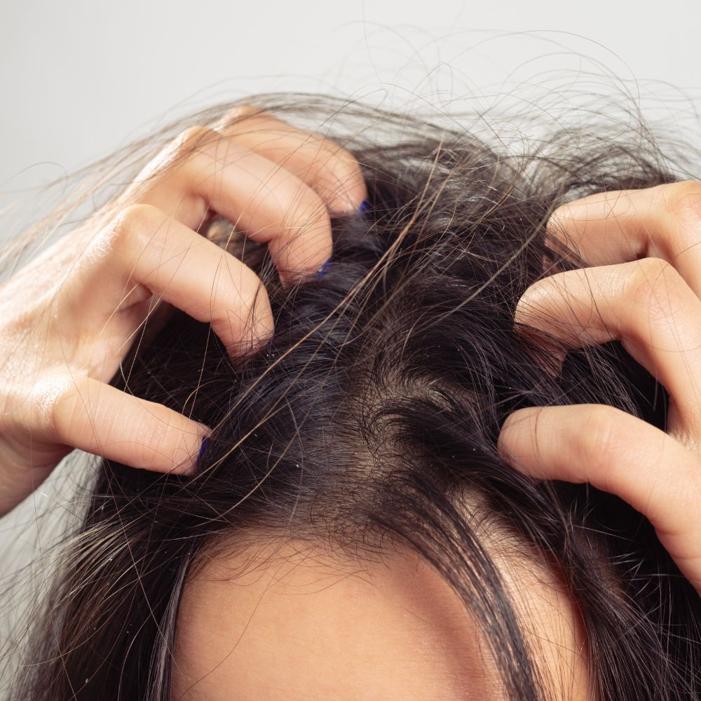 Khi ngứa, chúng ta thường có thói quen gãi mạnh. Việc này làm trầy xước da đầu, gây viêm nhiễm và làm yếu chân tóc, khiến tóc rụng hàng loạt