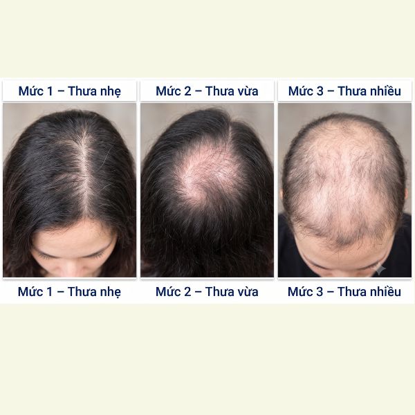 Tóc chị đang thưa ở mức nào?