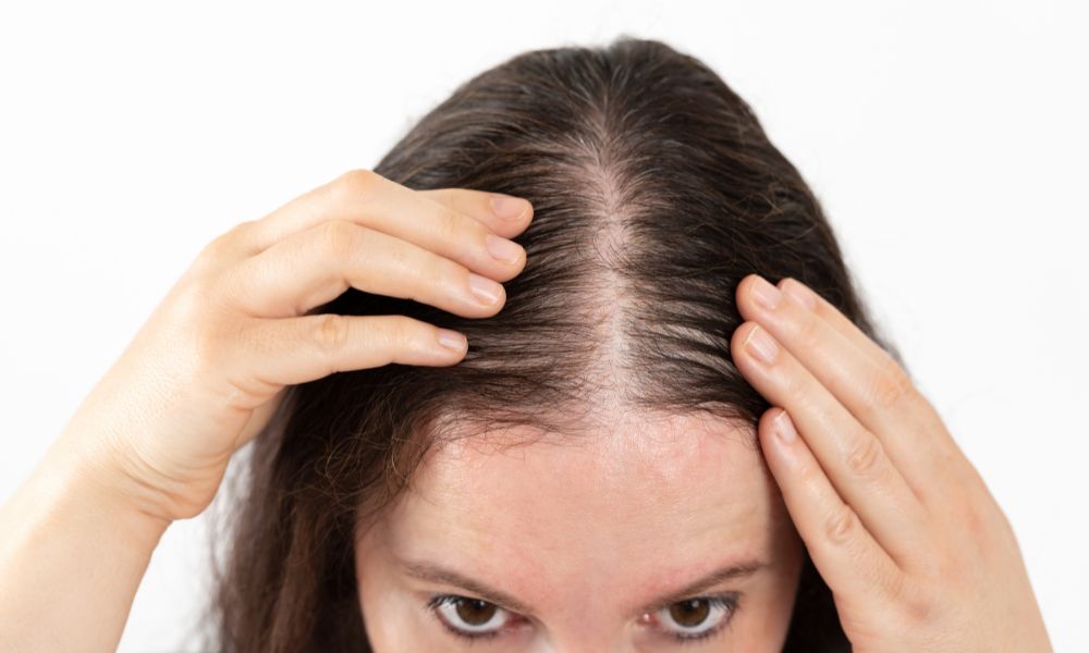 Tóc rụng lộ rõ da đầu: Đường ngôi tóc ngày càng rộng, tóc mỏng đến mức không thể che giấu bằng cách thay đổi kiểu tóc
