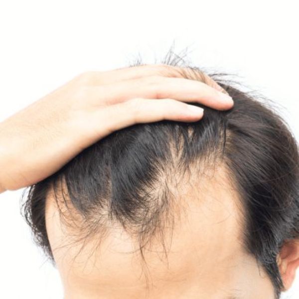 Tóc giả nam dành cho tình trạng hói