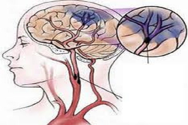 Tai Biến Mạch Máu Não Là Bệnh Gì?
