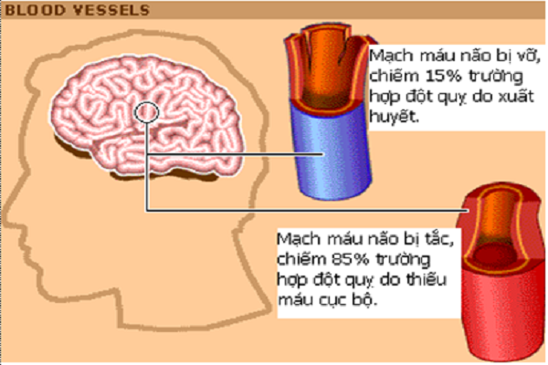 Đối Tượng Có Nguy Cơ Cao Bị Đột Quỵ