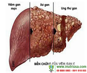 Fucoidan có thể trị viêm gan hay không?