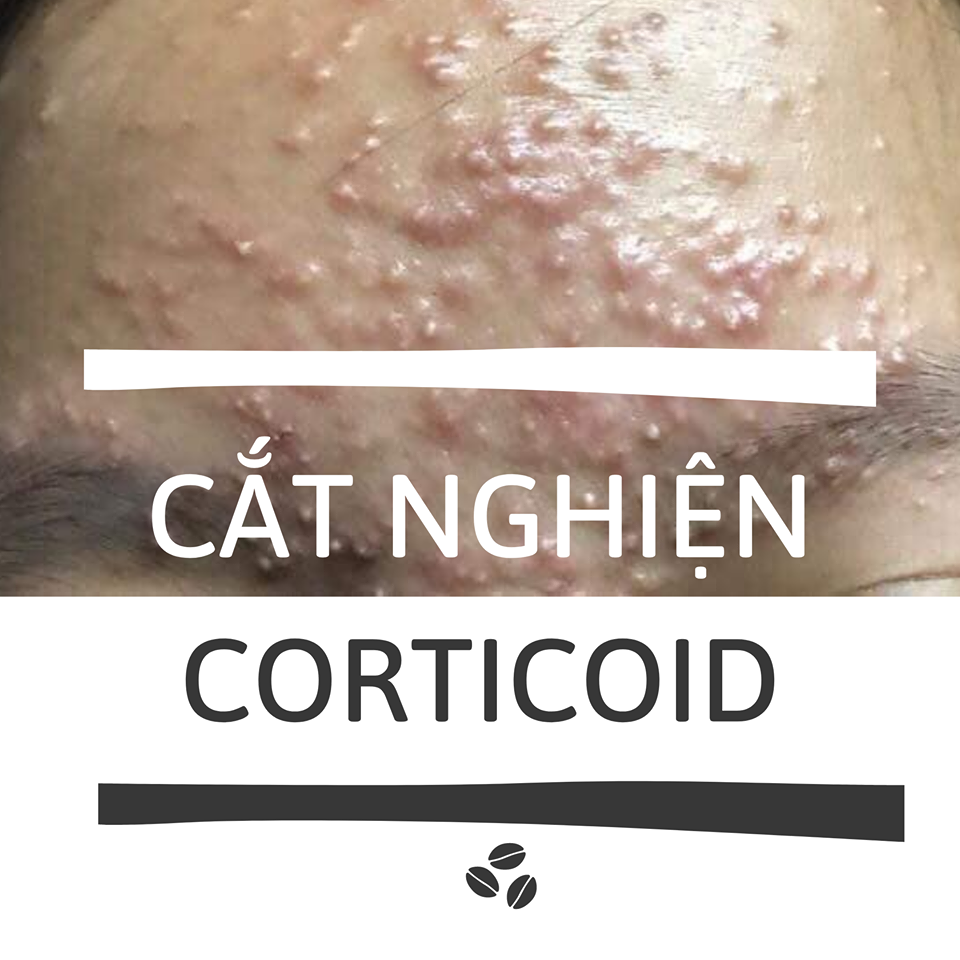 Cắt Nghiện Corticoid, Kem Trộn. Dấu Hiệu Nhận Biết Kem Trộn