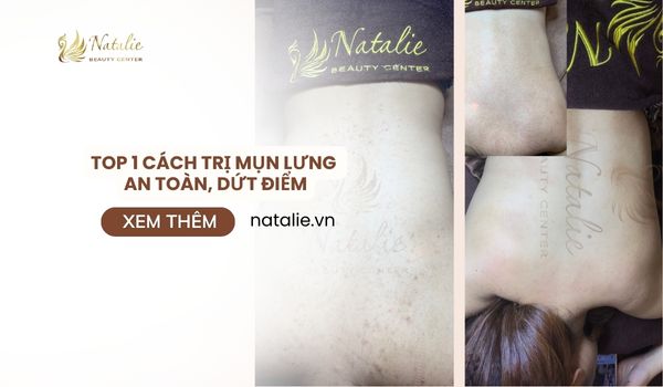 TOP 5 Cách Trị Mụn Lưng An Toàn, Dứt Điểm Nhanh Chóng