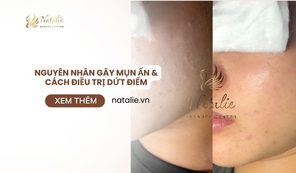 Nguyên Nhân Gây Mụn Ẩn & Cách Điều Trị Dứt Điểm