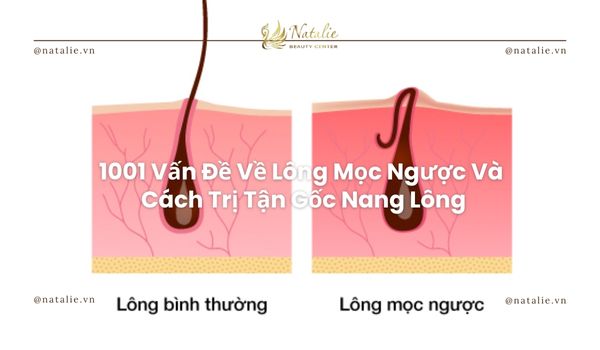 1001 Vấn Đề Về Lông Mọc Ngược Và Cách Trị Tận Gốc Nang Lông