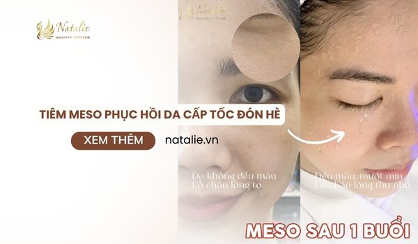 Tiêm Meso Phục Hồi Da Cấp Tốc Đón Hè. Lưu Ý Về Meso Giúp Đạt Hiệu Qủa Tốt Nhất