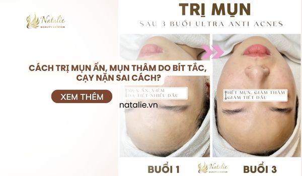 Cách Trị Mụn Ẩn, Mụn Thâm Do Bít Tắc, Cạy Nặn Sai Cách?