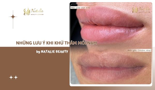 Những Lưu Ý Khi Khử Thâm Môi Nam