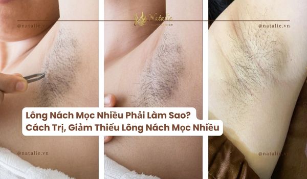 Lông Nách Mọc Nhiều Phải Làm Sao? Cách Trị, Giảm Thiểu Lông Nách Mọc Nhiều