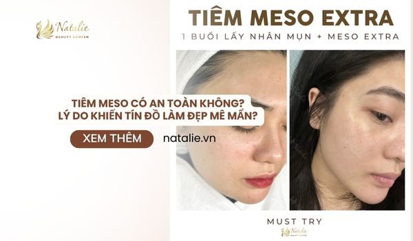 Góc Giải Đáp: Tiêm Meso Có An Toàn Không? Lý Do Khiến Tín Đồ Làm Đẹp Mê Mẩn? 