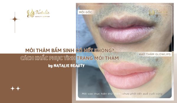 Môi Thâm Bẩm Sinh Có Hết Không? Cách Khắc Phục Tình Trạng Môi Thâm