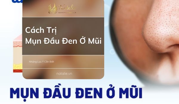 Cách Trị Mụn Đầu Đen Ở Mũi? Những Lưu Ý Cần Biết?