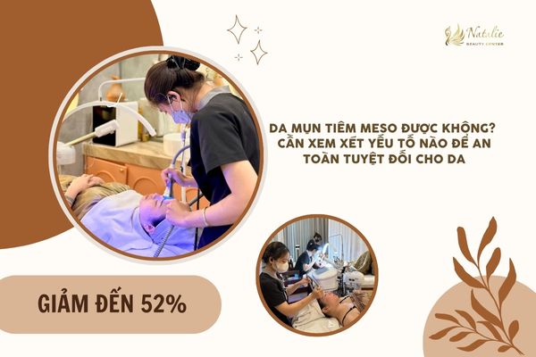 Da Mụn Tiêm Meso Được Không? Cần Xem Xét Yếu Tố Nào Để An Toàn Tuyệt Đối Cho Da