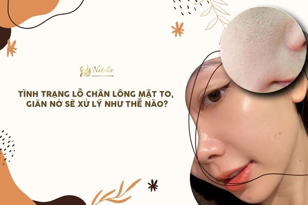 Xử Lý Tình Trạng Lỗ Chân Lông Mặt To, Giãn Nở Đón Tết?