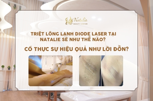 Triệt Lông Lạnh Diode Laser Tại Natalie Sẽ Như Thế Nào? Có Thực Sự Hiệu Quả Như Lời Đồn?