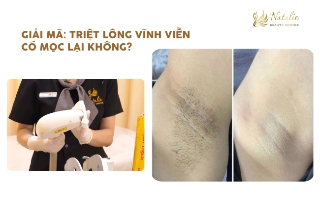 Giải Mã: Triệt lông vĩnh viễn có mọc lại không?