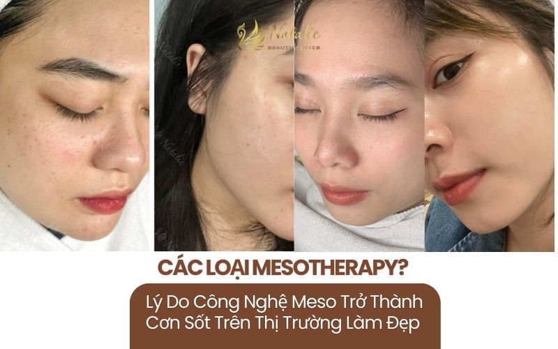 Các Loại Mesotherapy? Lý Do Công Nghệ Meso Trở Thành Cơn Sốt Trên Thị Trường Làm Đẹp