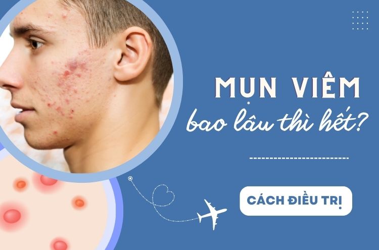 Mụn Viêm Bao Lâu Thì Hết? Cách Điều Trị Mụn Viêm Tại Nhà