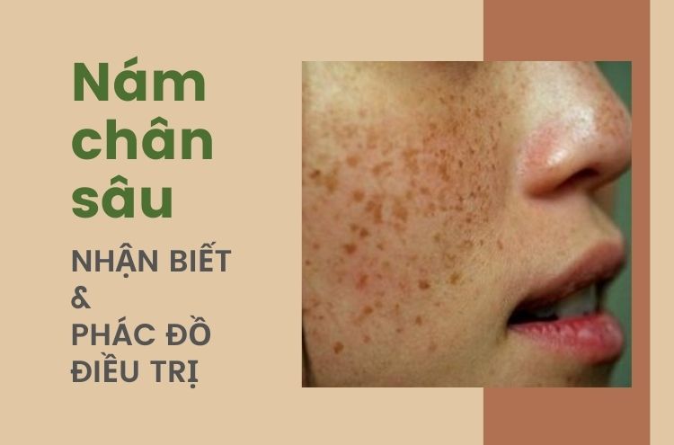 Nám Chân Sâu Là Gì? Phác Đồ Điều Trị Nám Chân Sâu